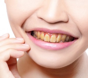 Close-up of smiling mouth with yellow stained teeth.