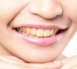 Close-up of a smiling mouth with stained teeth.