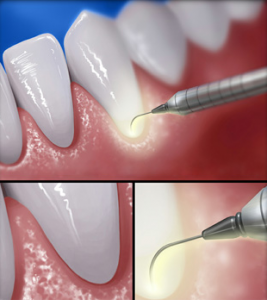 Dental scaler cleaning plaque from teeth near gums.