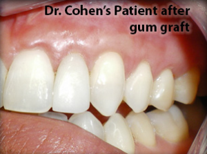 Close-up of healthy gums and teeth after gum graft surgery.