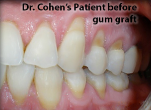Close-up of teeth with gum recession before grafting.