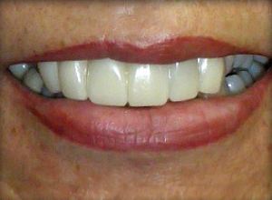 Close-up of a smile showing white, evenly aligned teeth and lips.