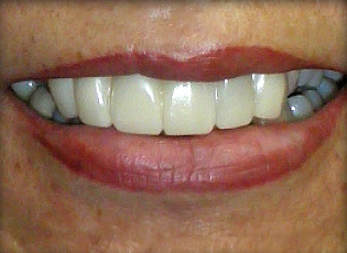 dental implant 1 after