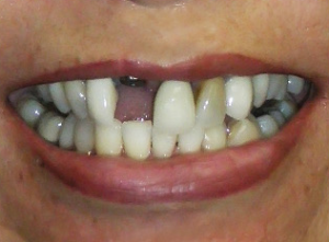 Close-up of a smile with missing and misaligned teeth.