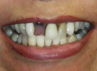 dental implant 1 before