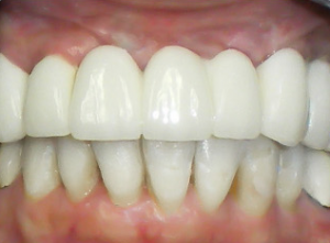 Close-up of upper and lower teeth showing dental work.