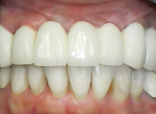 dental implant 2 after