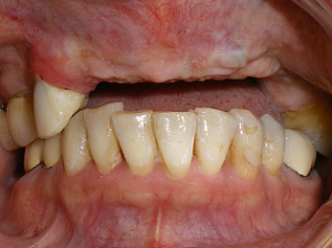 Close-up of lower front teeth with visible gum recession.
