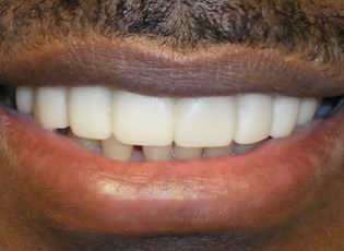 dental implant 3 after