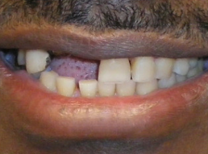 Close-up of a person's mouth showing missing and damaged teeth.