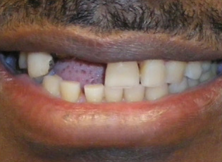 dental implant 3 before