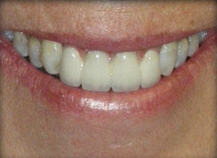 dental implant 4 after