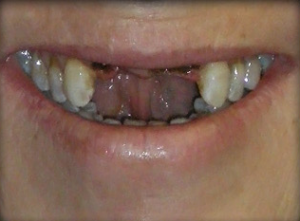 A close-up of a smile showing missing and decayed teeth.