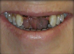 dental implant 4 before