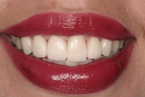 guided dental implants after-1