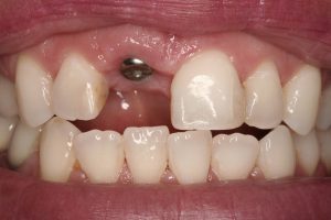 guided dental implants before-1
