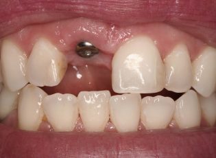 guided dental implants before-1