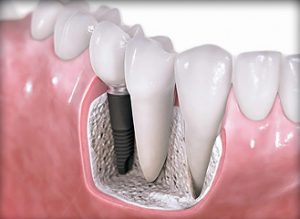 guided dental implants