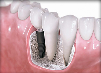 guided dental implants