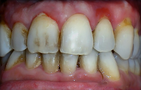 gum disease bigger