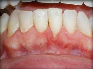 Close-up of lower front teeth and gums showing redness.