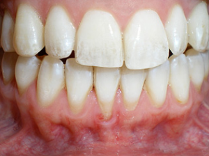 Close-up of teeth showing signs of gum recession and plaque buildup.