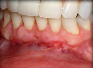 Inflamed gums with redness and sores below the lower teeth.