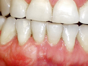Close-up of healthy lower front teeth and gums.