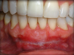 Close-up of gums showing redness and inflammation below healthy teeth.