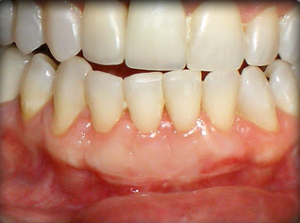 Close-up of human lower front teeth and gums with noticeable gum recession.