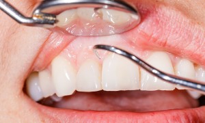Close-up of dental tools inspecting healthy gums and teeth.