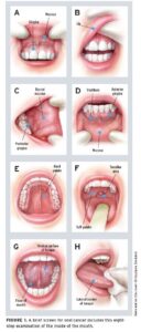 Eight-step oral cancer examination diagram.