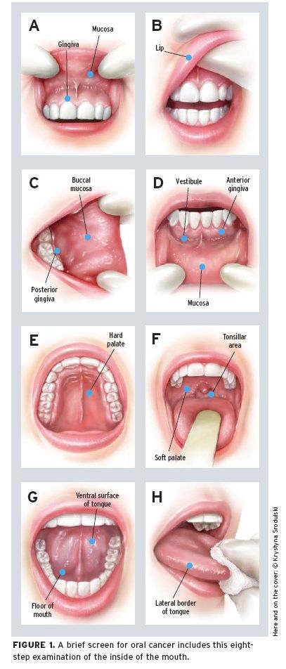 Oral Cancer Specialist La Gum Doctor Dr Mark Cohen