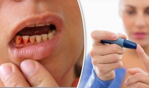 Close-up of a person showing decayed teeth with a hand holding a dental tool.