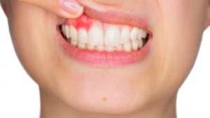 Close-up of inflamed gums above healthy teeth.