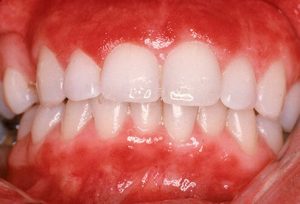Close-up of healthy gums and teeth showing natural alignment.