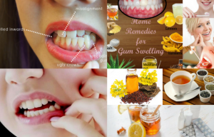 Home remedies for gum swelling with natural ingredients.